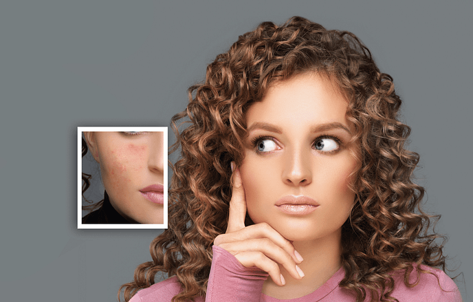 How to get rid of acne-2